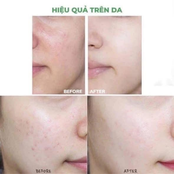 Kem mụn – kiềm dầu DERMACOS Anti-Acne Farmona 50ml