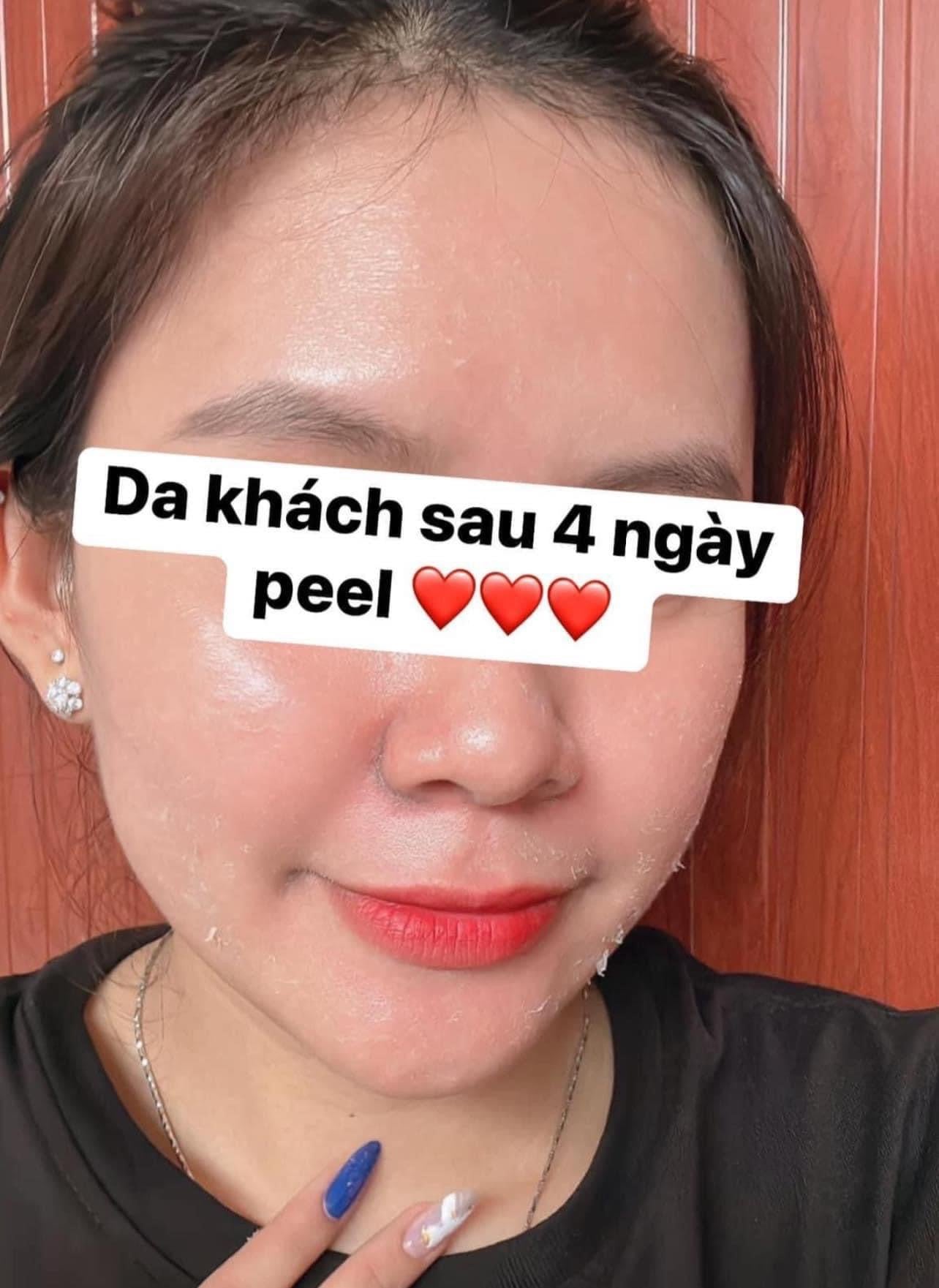 Kem Peel tái tạo đều màu da, giảm mụn VITAMIN A 5% INNOAESTHETICS Inno Exfo Lightening 15g