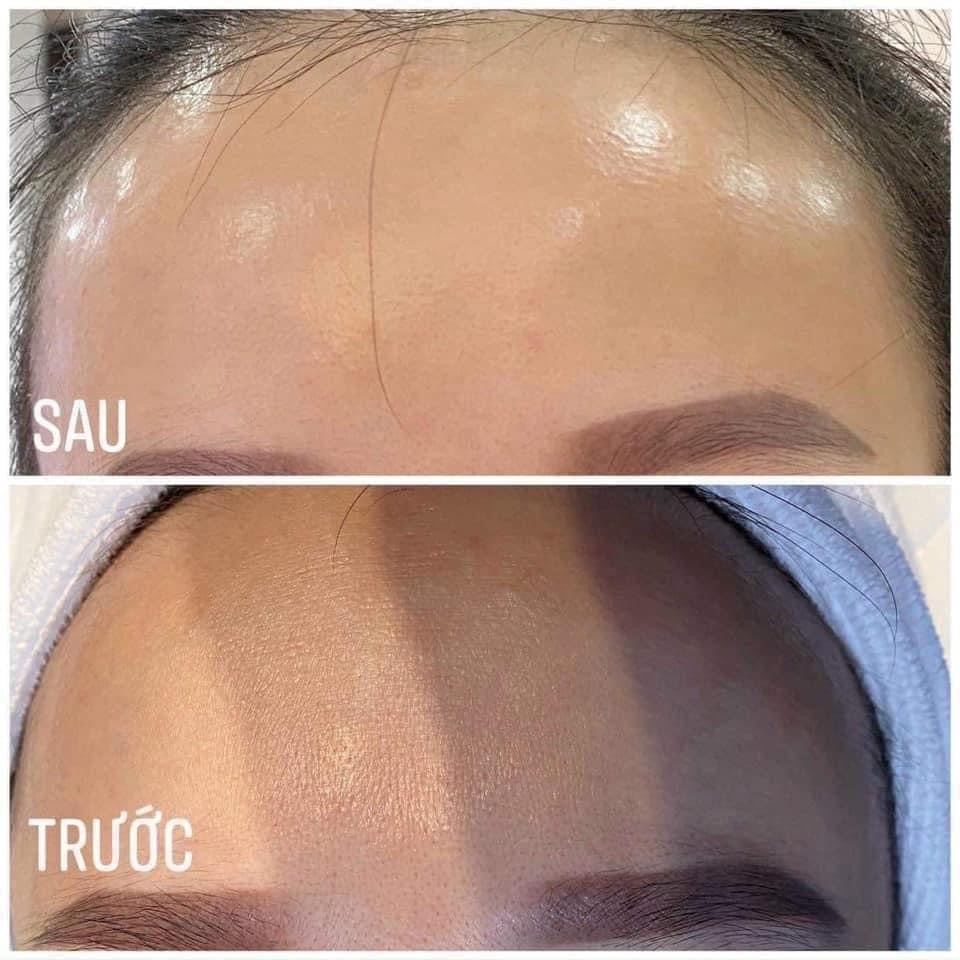 Kem Peel tái tạo đều màu da, giảm mụn VITAMIN A 5% INNOAESTHETICS Inno Exfo Lightening 15g