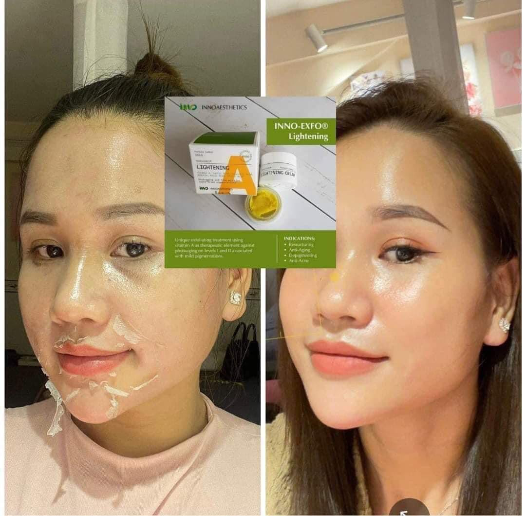 Kem Peel tái tạo đều màu da, giảm mụn VITAMIN A 5% INNOAESTHETICS Inno Exfo Lightening 15g