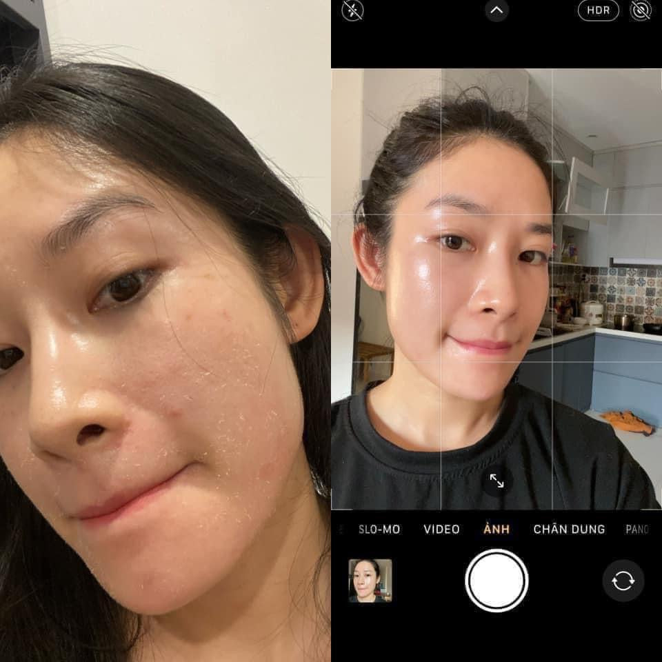 Kem Peel tái tạo đều màu da, giảm mụn VITAMIN A 5% INNOAESTHETICS Inno Exfo Lightening 15g
