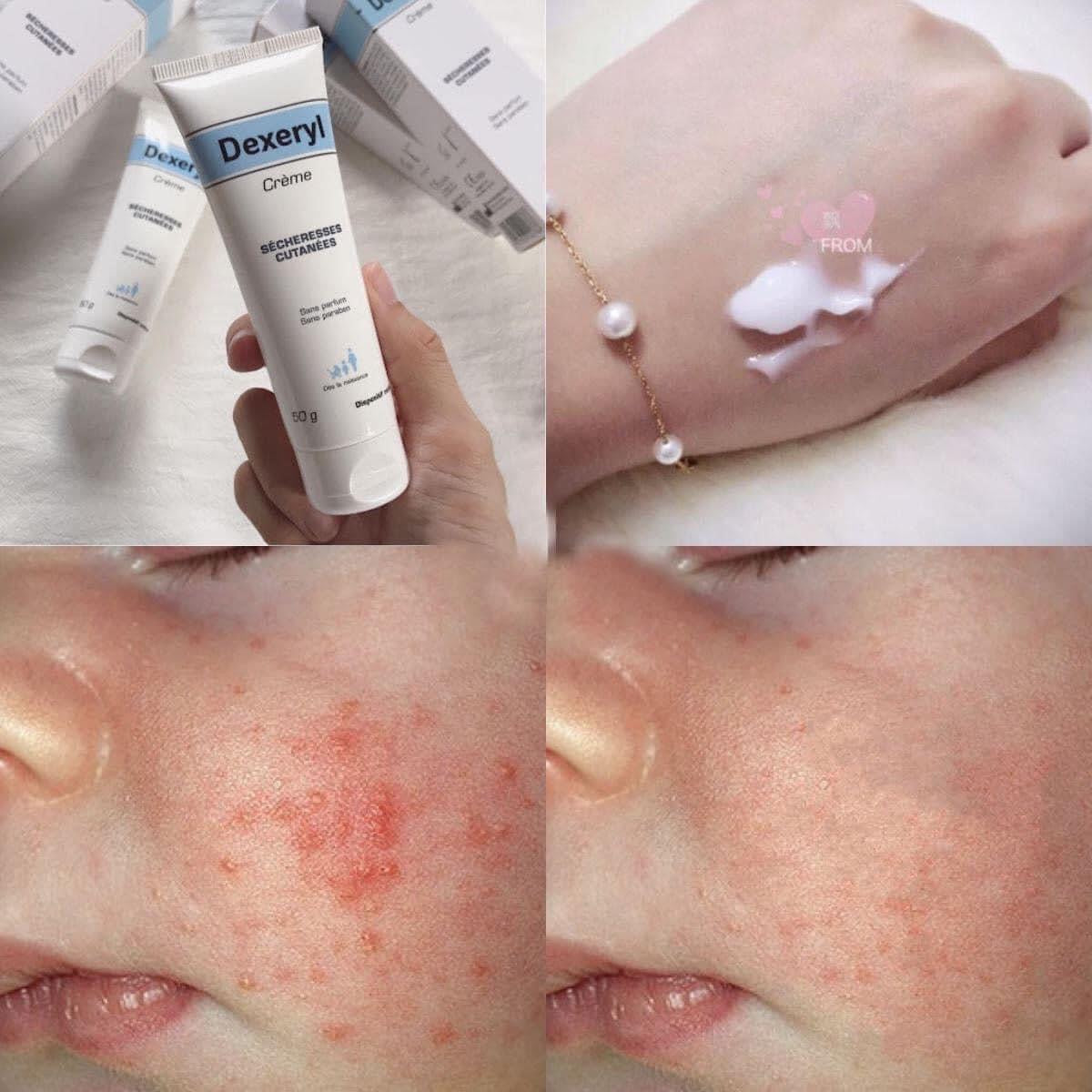 Kem nẻ DEXERYL Pháp