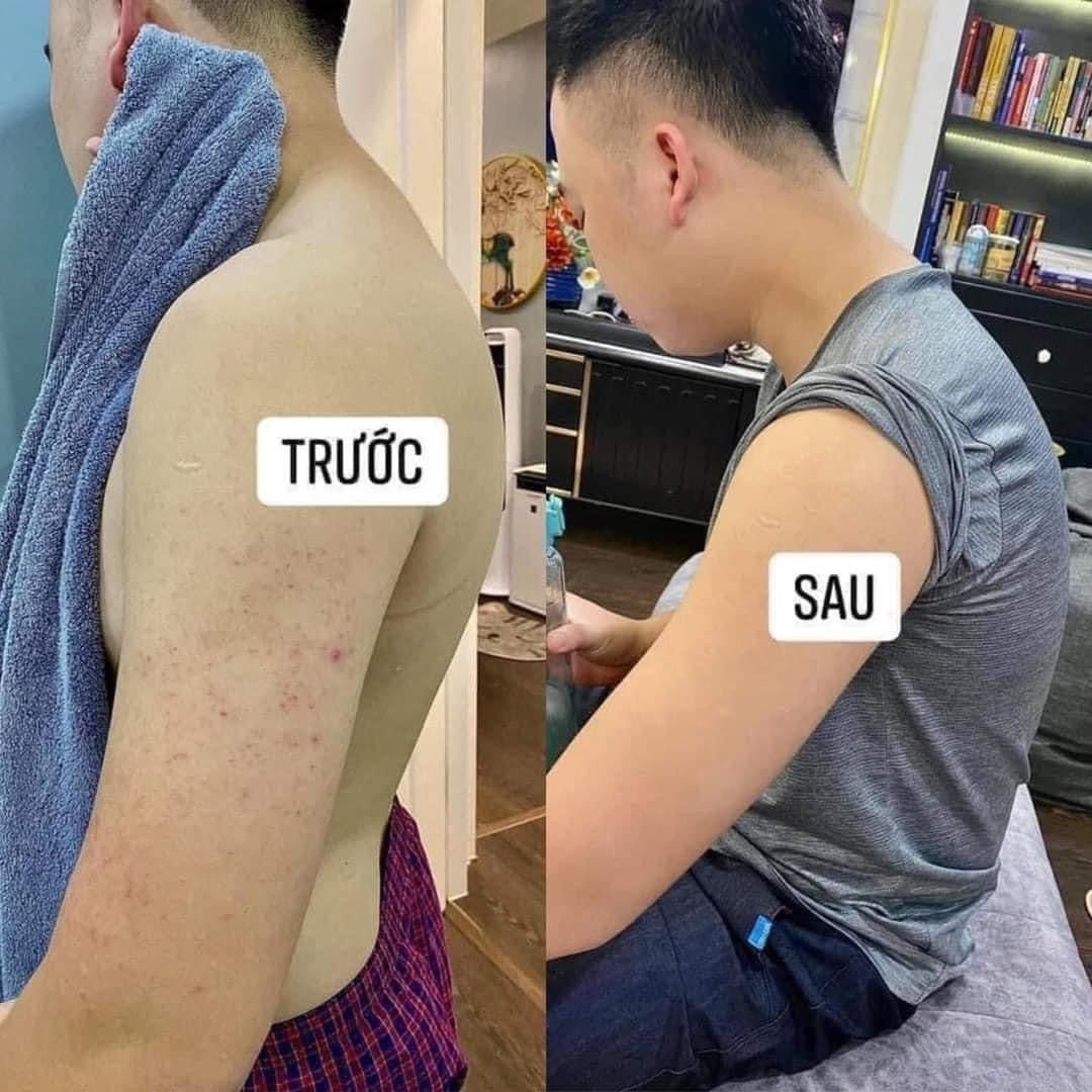 Sữa tắm trị mụn lưng và viêm lỗ chân lông ADERMA 500ml