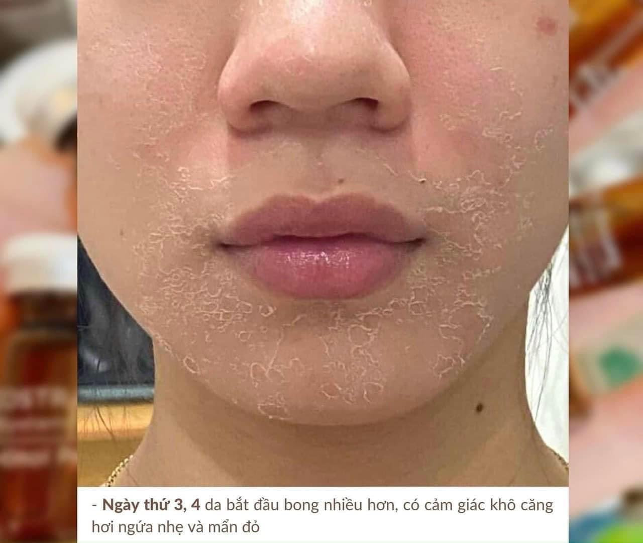 Peel da sinh học Retinol NEOSTRATA ProSystem 1.5ml