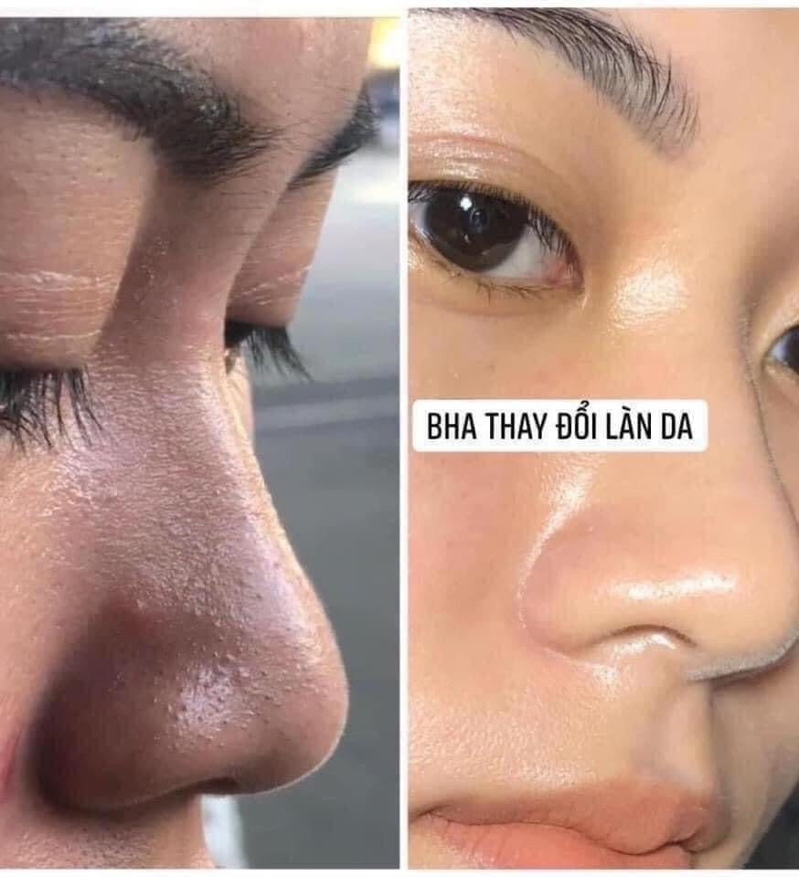 Toner tẩy da chết hoá học BHA OBAGI Pore Therapy 148ml