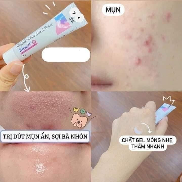 Gel chấm mụn KLENZIT MS (Ấn Độ) 15g
