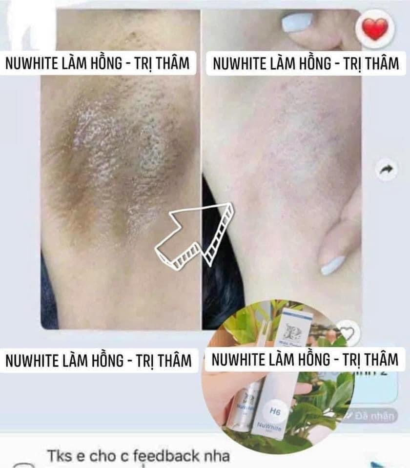 Kem trị thâm làm hồng NUWHITE Mỹ (5ml)